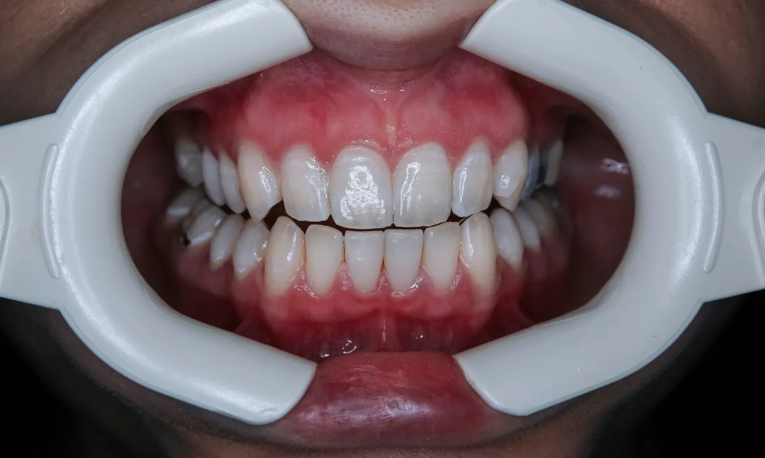 whitened teeth | elements dental