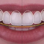 smile design treatment | Elements Dental