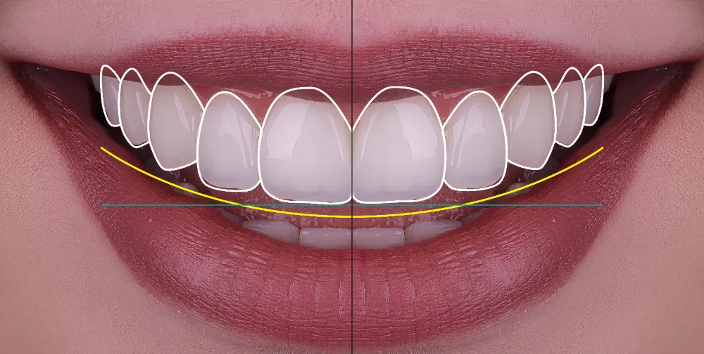 smile design treatment | Elements Dental