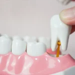 wisdom tooth removal singapore | Elements Dental