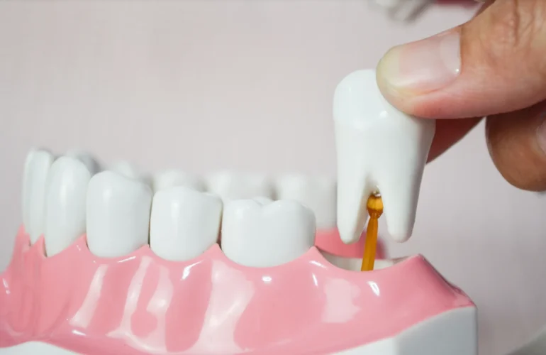 wisdom tooth removal singapore | Elements Dental