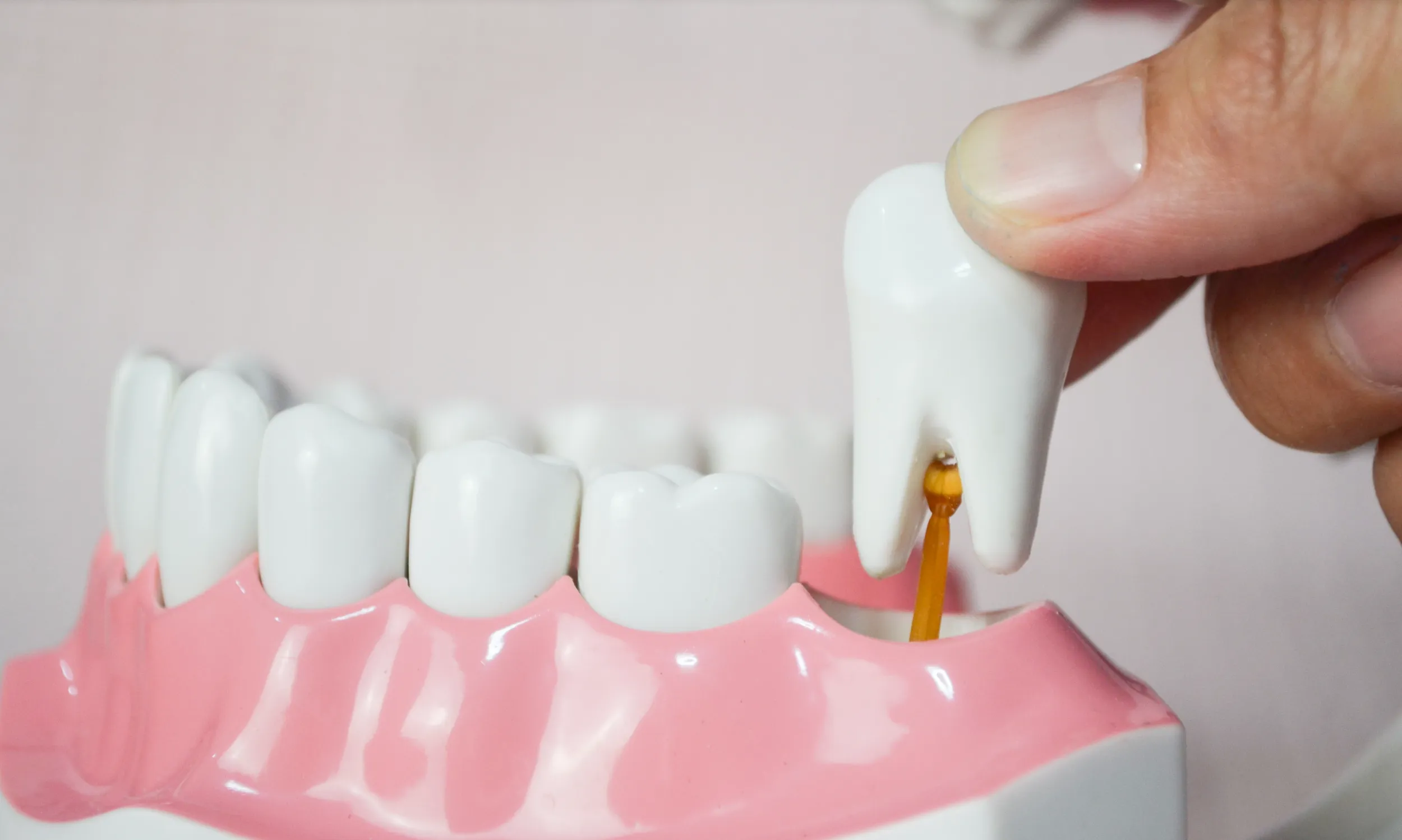 wisdom tooth removal singapore | Elements Dental