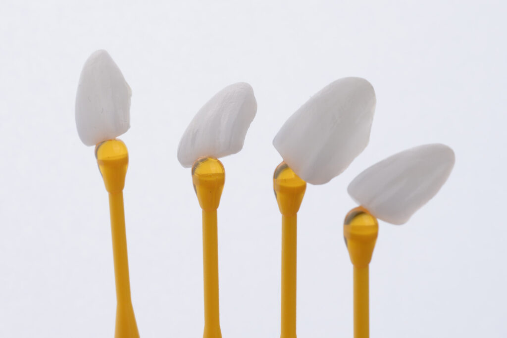 4 ceramic veneers for a smile makeover