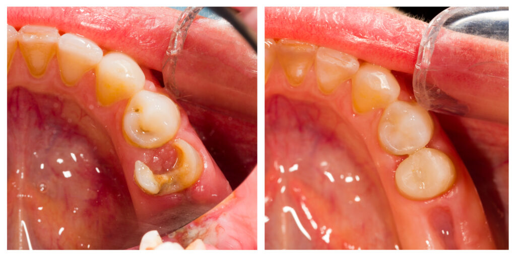 Before and after dental fillings
