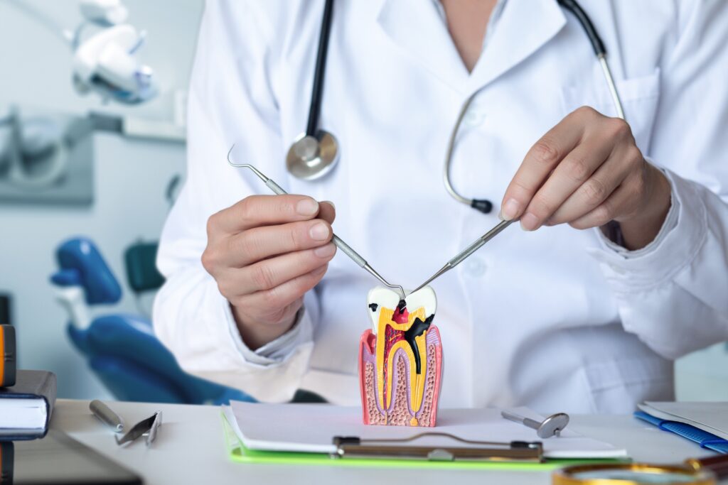 Dentist showing a model of a damaged tooth in need of dental filling upgrade