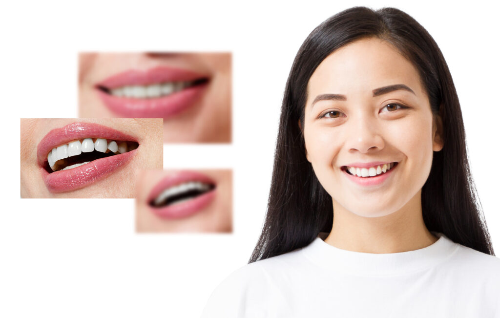 Patient with a successful smile makeover in Singapore