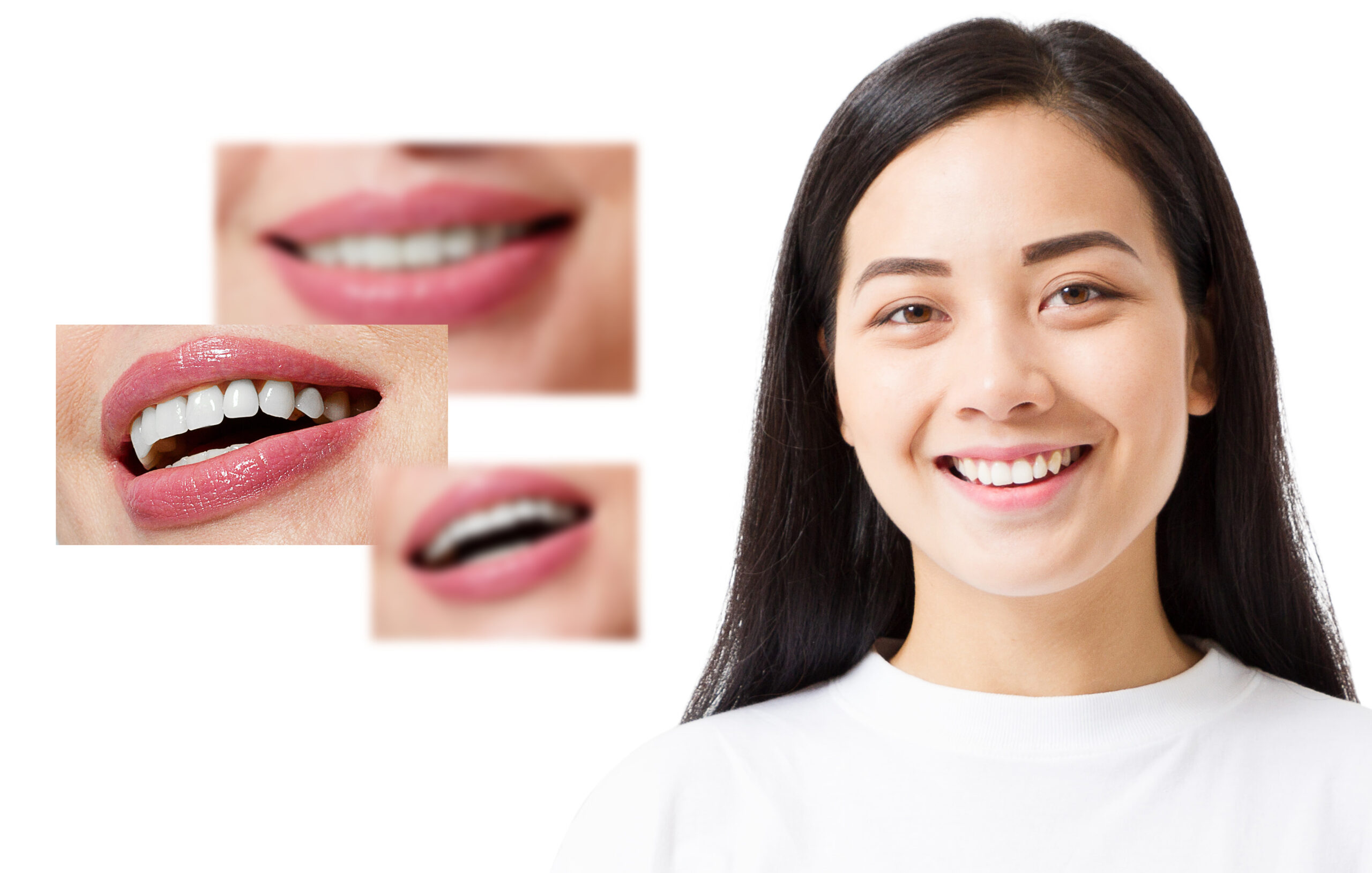 Patient with a successful smile makeover in Singapore
