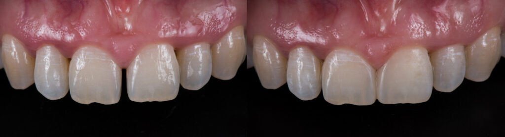 before and after: dental composite bonding used to close a tooth gap