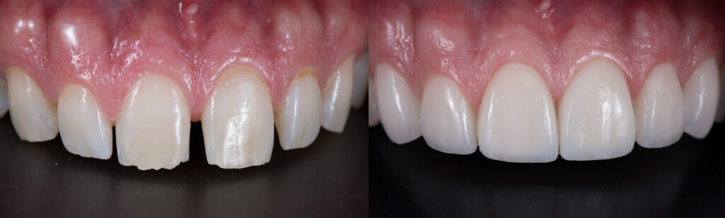 before and after: space gap correct with ceramic veneers
