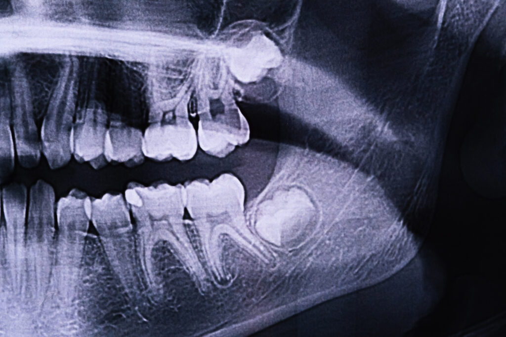 A panoramic dental X-ray showing impacted wisdom teeth pressing against other teeth and requiring wisdom tooth removal.
