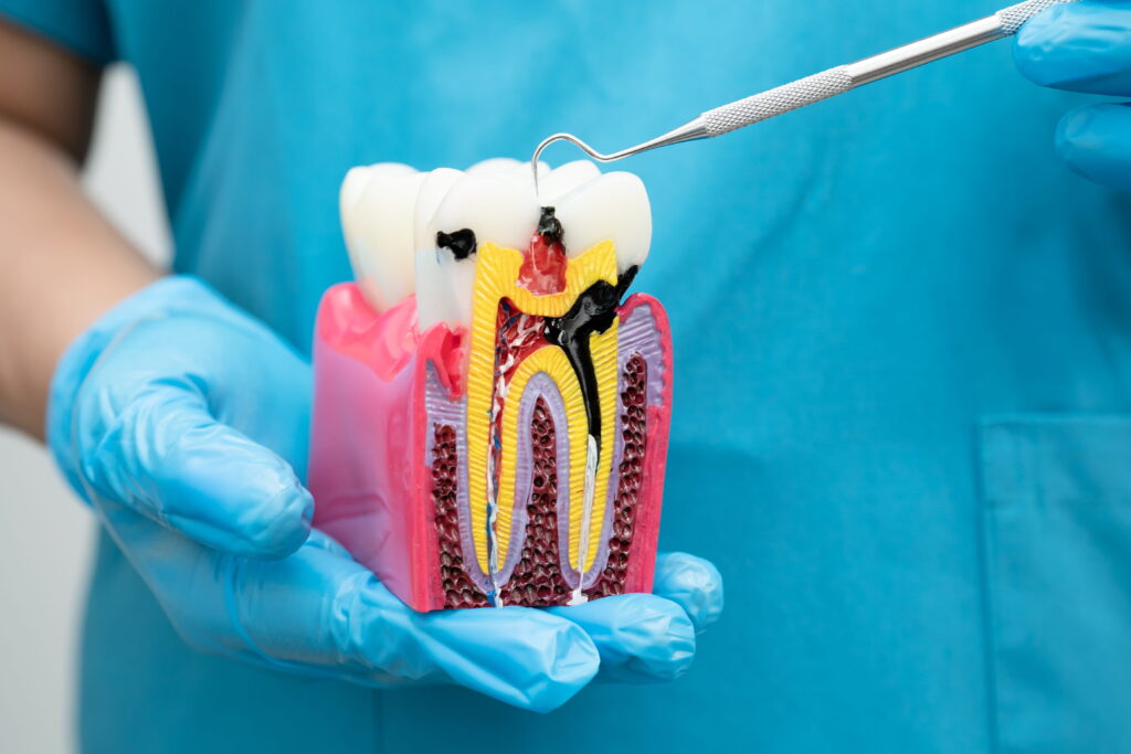 Tooth model showing decay and infection reaching the pulp, explaining when a tooth may require root canal treatment or extraction