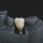 an image of a model dental crown placed in between model teeth