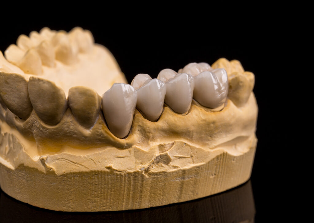 dental crown material in Singapore - all porcelain, ceramic