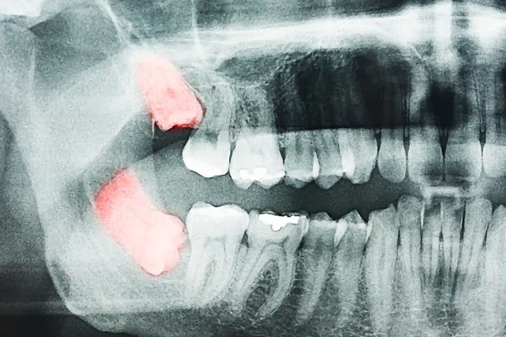 An X-ray showing impacted wisdom teeth, highlighted in red. It indicates that the patient must undergo wisdom tooth removal in Singapore