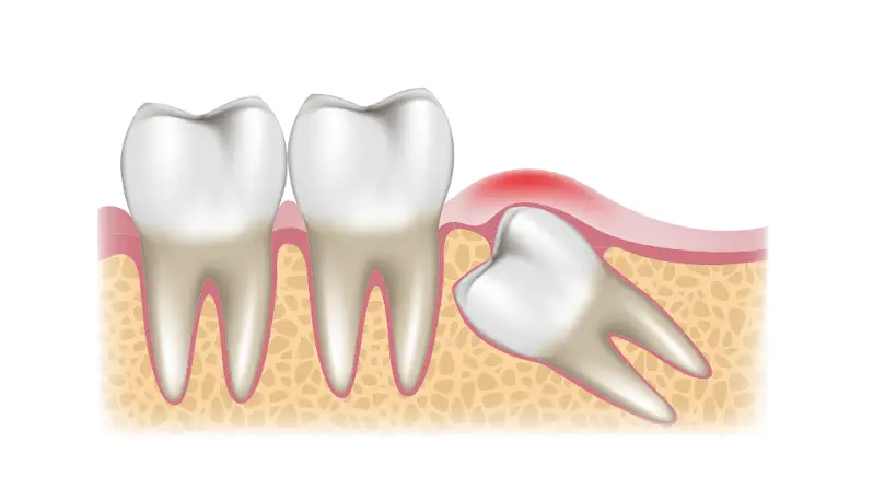 A mesioangular impacted wisdom tooth that fails to erupt beneath the gumline.