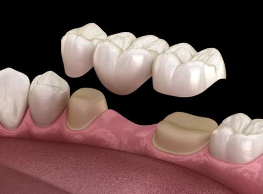 A bridge mounted on two adjacent crowns, a type of tooth replacement option
