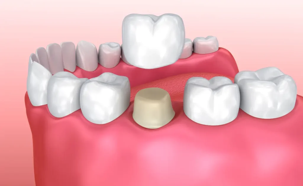 A prepped tooth about to be fitted with a crown, a tooth replacement option wherein the existing tooth doesn't have to be removed