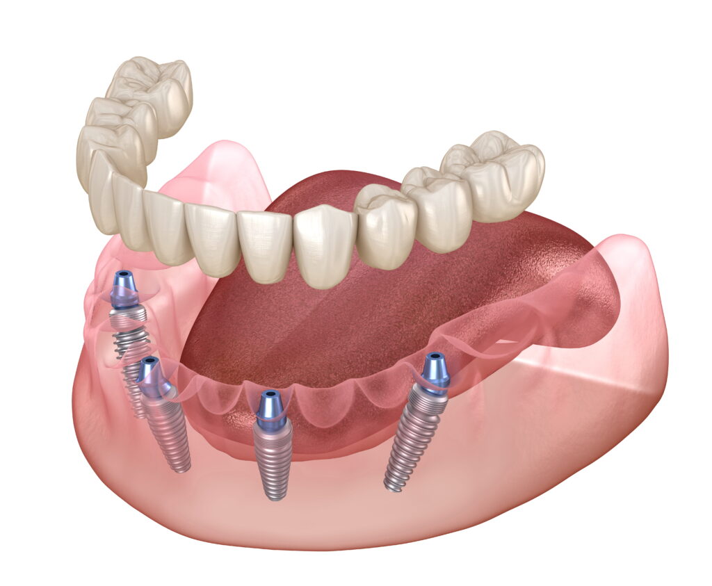 All-on-4, an implant-based tooth replacement option that gives the patient a complete arch of teeth
