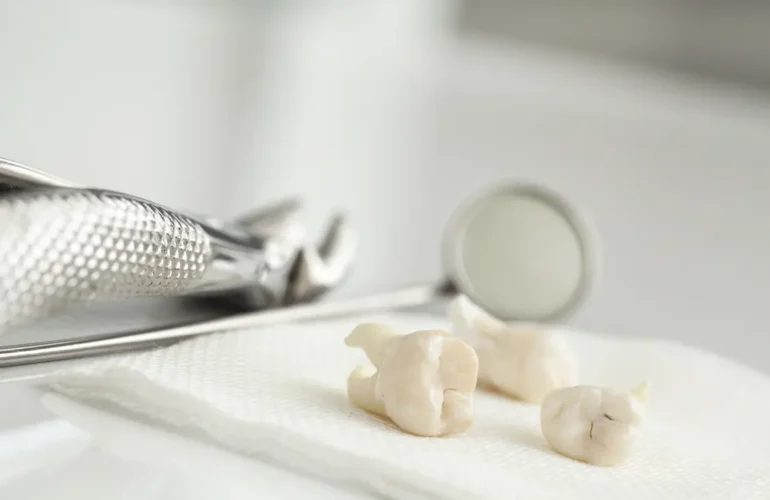 Extracted teeth and dental tools placed on gauze, showing what to expect after a dental extraction procedure