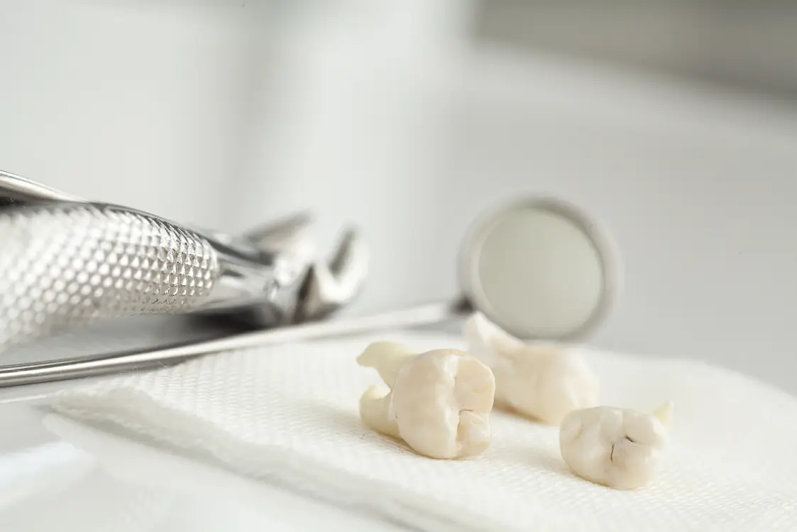 Extracted teeth and dental tools placed on gauze, showing what to expect after a dental extraction procedure