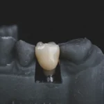 a dental implant on a grey model, a type of tooth replacement option