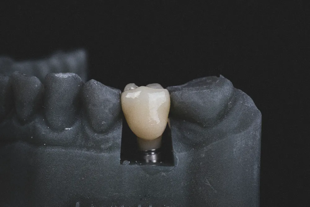 a dental implant on a grey model, a type of tooth replacement option