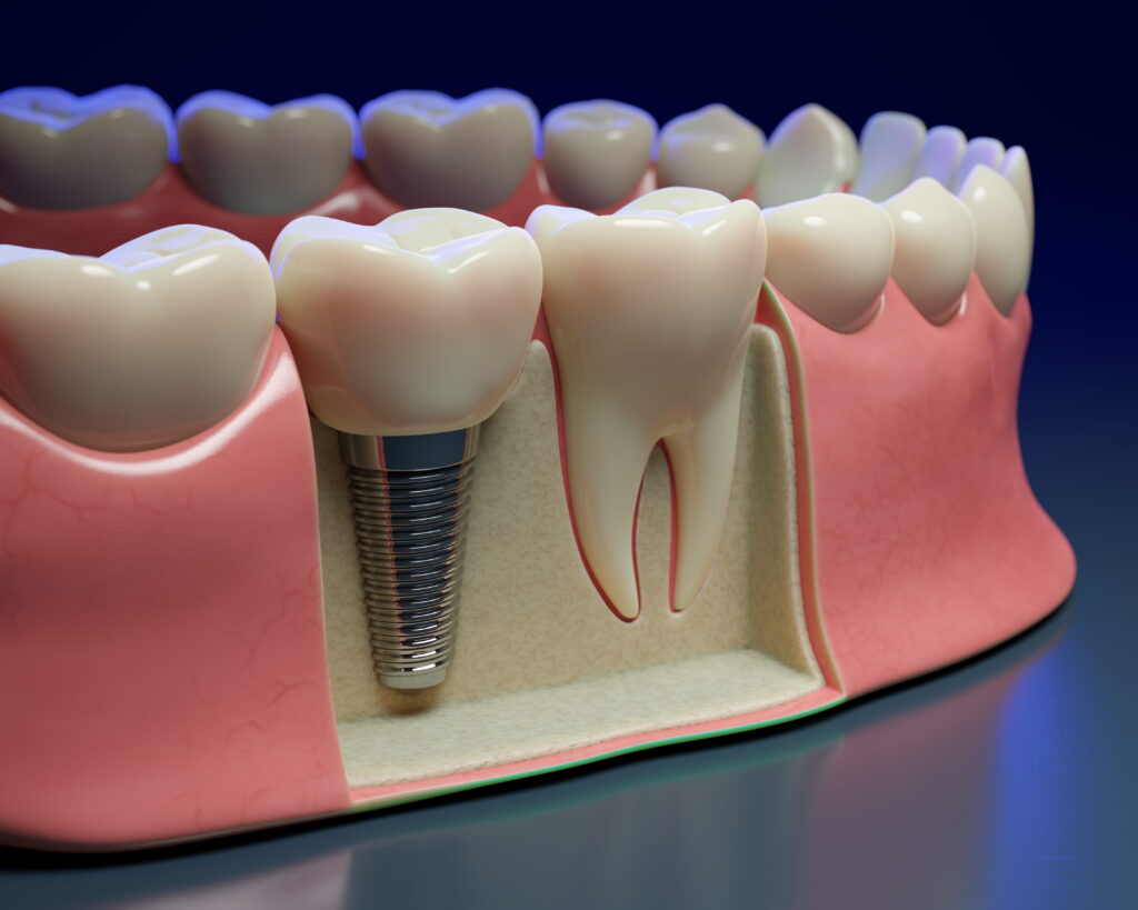 a model view of a dental implant imbued within a patient's bone, a type of tooth replacement