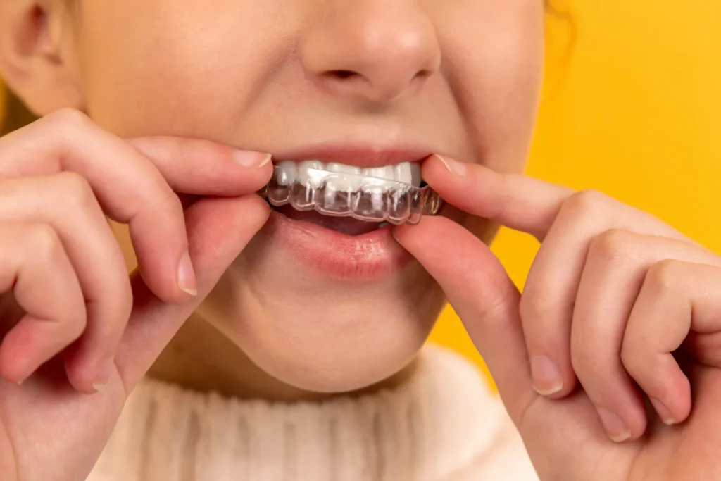 a patient putting on invisalign braces on her teeth, a service that can be provided by a bukit timah dentist