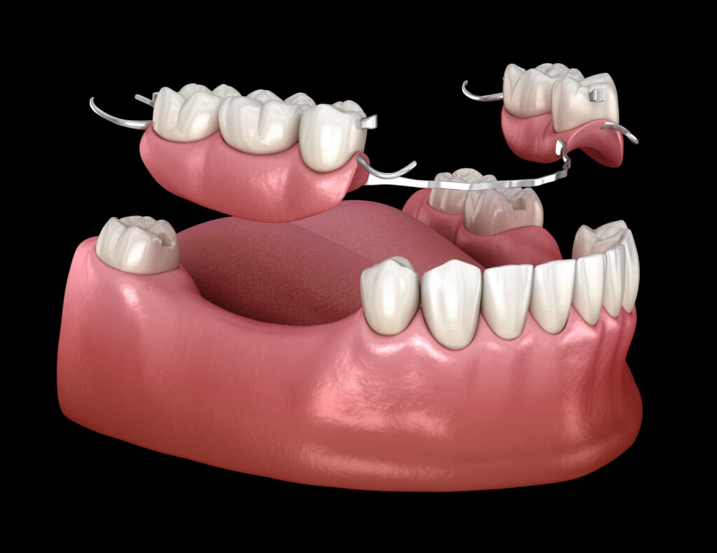 removable partial dentures, a tooth replacement option if the patient is missing multiple teeth