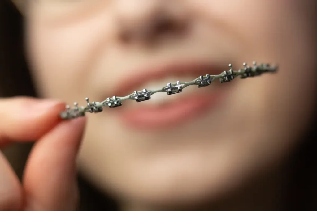 A young lady holding her brackets and wire in front of her mouth, a kind of appliance for orthodontics in Singapore