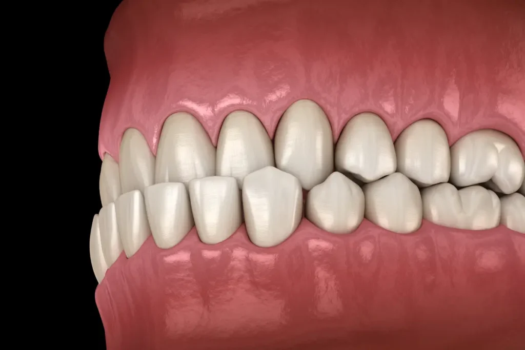 An underbite is a class 3 malocclusion requiring orthodontics in Singapore
