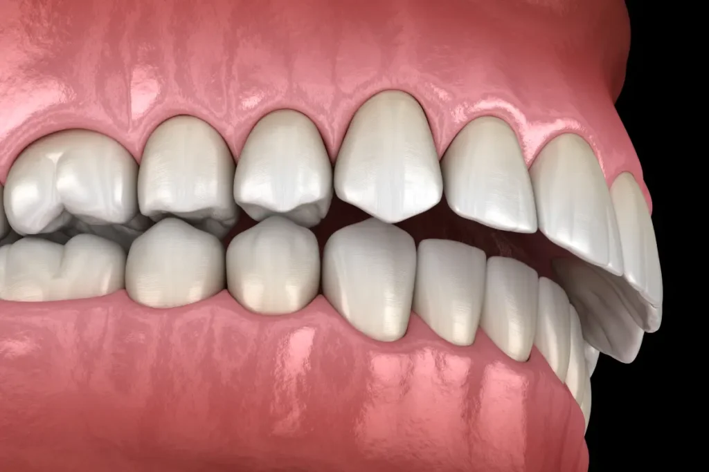 Illustration of a Class II malocclusion showing increased overjet between upper and lower front teeth needing an orthodontist.
