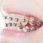 Self-ligating braces are a solution for orthodontics in Singapore