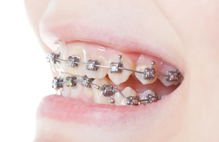 Self-ligating braces are a solution for orthodontics in Singapore