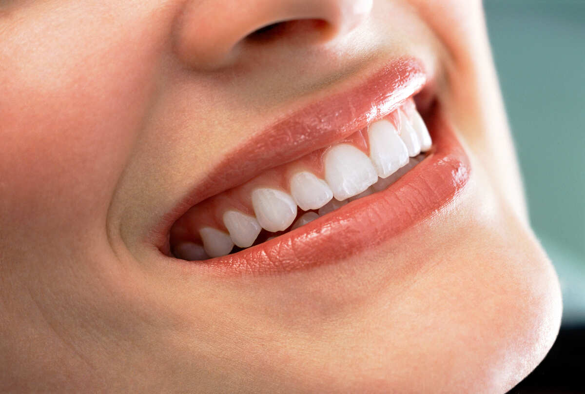 a close up shot of a woman's smile makeover in Singapore