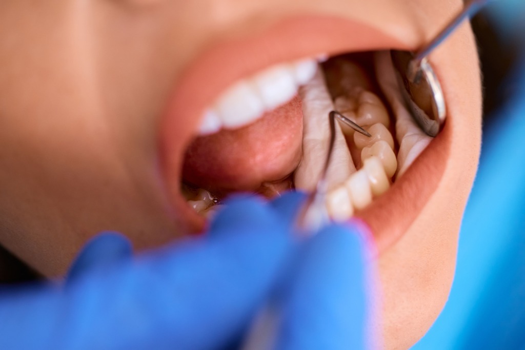 a close-up shot of teeth being checked to find any possible sign of teet filling failing