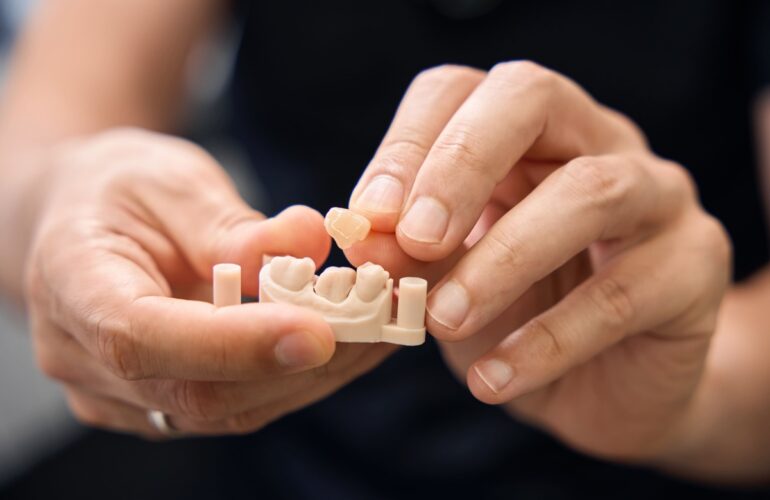 a dental professional holding a model of a dental crown in Singapore