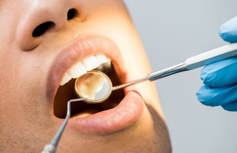 an image of a man's teeth being checked by a dentist for a possible failing teeth filling in Singapore