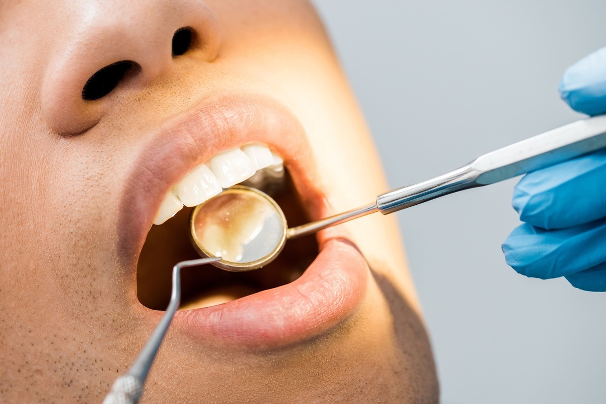 an image of a man's teeth being checked by a dentist for a possible failing teeth filling in Singapore