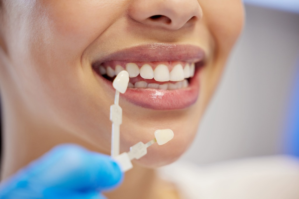 an image showing a close-up shot of a woman's teeth during a dental check and a couple of tooth samples being used to compare shades for the perfect smile makeover